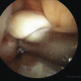 2010-ACL-Reconstruction-(11)