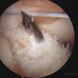 2010-ACL-Reconstruction-(15)