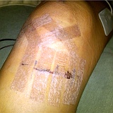 2010-ACL-Reconstruction-(32)